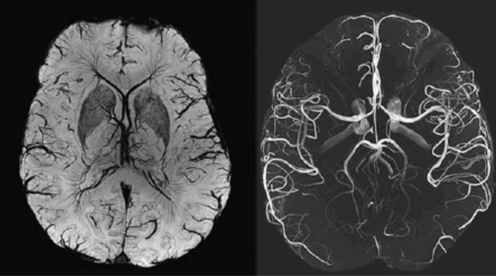 Novo Nordisk (NVO) Leads Alzheimer’s Prevention Race, But Eli Lilly (LLY) Could Win the Market