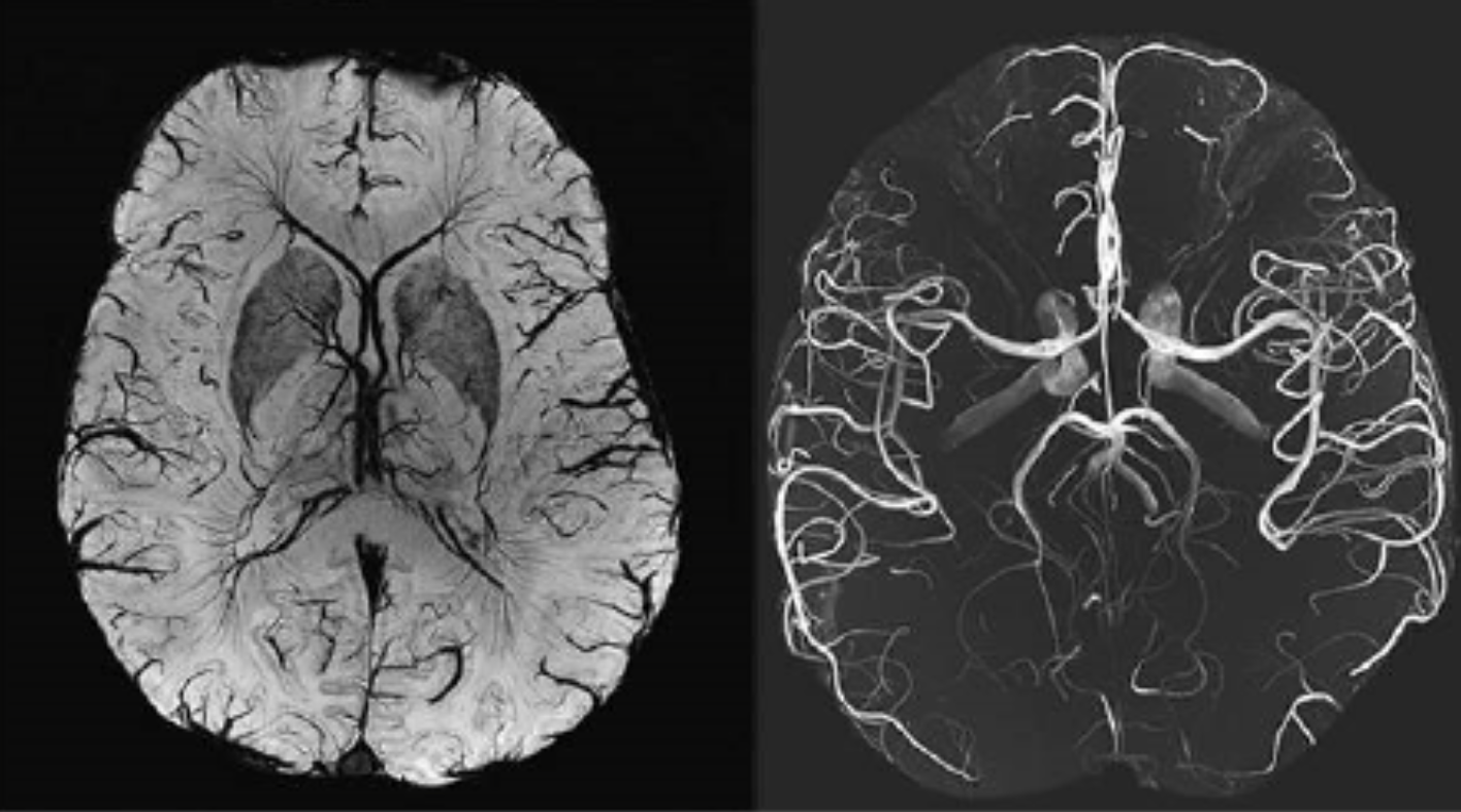 Novo Nordisk (NVO) Leads Alzheimer’s Prevention Race, But Eli Lilly (LLY) Could Win the Market